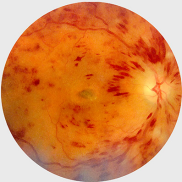 An image of an eye with non-diabetes-related issues. 