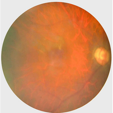 An image of an eye with unassessable results